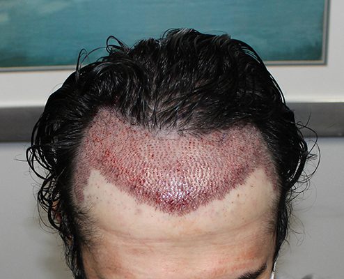Hair Transplant A Promise Of Restoration And Confidence Hustle And