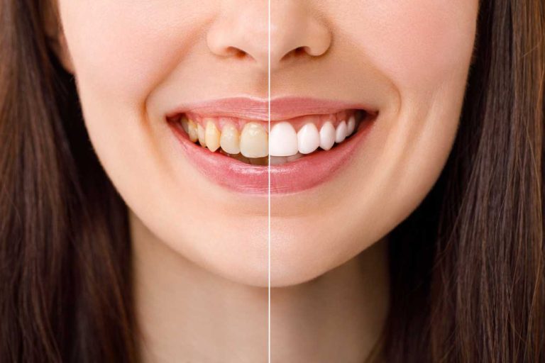 Teeth Whitening Solution: Achieve A Bright Smile